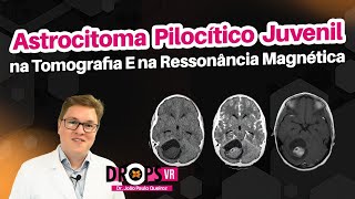 ASTROCITOMA PILOCÍTICO JUVENIL COMO RECONHECER NA TC E RM I VOCÊ RADIOLOGISTA [upl. by Nylekoorb]