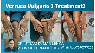 Viral wartsverruca vulgaris It’s treatment and prevention Dr Uttam Kumar Lenka [upl. by Dari]