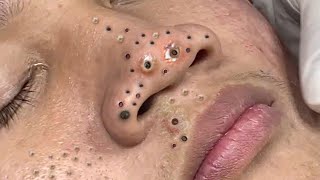 Big Cystic Acne Blackheads Extraction Blackheads amp Milia Whiteheads Removal Pimple Popping  389 [upl. by Cesaria]