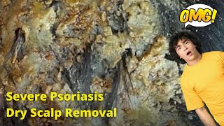 Removal of SEVERE Psoriasis Seborrheic Dermatitis Dry Scalp amsr [upl. by Addie]