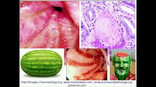 Histopathology  Gastric Antral Vascular ectasia GAVE [upl. by Atoiyanap]