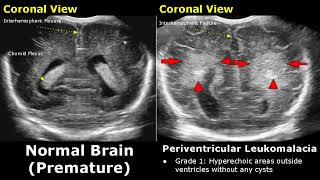 Neonatal Brain Ultrasound Normal Vs Abnormal Images  Full Term Infant amp Premature Newborn Head USG [upl. by Dempsey]