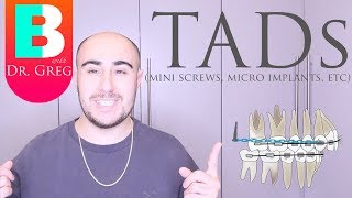 BRACES EXPLAINED TADs  Mini Implants [upl. by Ecnarual222]