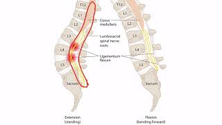 Lumbar Radiculopathy for the USMLE Step 1 [upl. by Ronnica822]