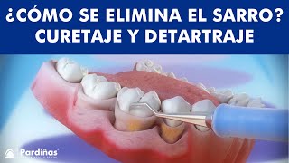 ¿Cómo se ELIMINA EL SARRO  Curetaje y limpieza dental © [upl. by Noislla]