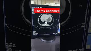 abdomen ct scan ct scanabdomenctanatomy ct scan [upl. by Eissen]