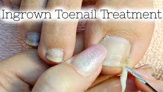 Pedicure Tutorial Ingrown Toenail Treatment At Home How to Recut Nail Groove to Eliminate Pain [upl. by Aronoel]