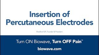 Insertion of Biowave Percutaneous Electrodes [upl. by Genevra96]