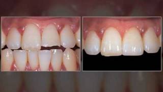 Veneers  Chipped Tooth [upl. by Neehs]