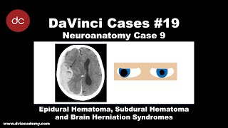 Epidural vs Subdural Hematoma and Brain Herniation Syndromes Case DaVinciCases Neuroanatomy 9 [upl. by Jaymie]