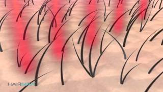 LASER LIGHT THERAPY FOR HAIR LOSS IN WOMEN DR DRAY [upl. by Learsiy564]