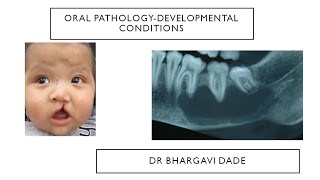 Oral pathology Developmental conditions INBDE [upl. by Roselani]