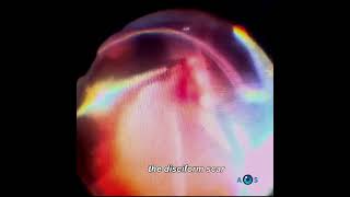 Posterior Vitrectomy for Removing a Fibrotic Disciform Scar [upl. by Lehcyar]