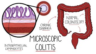 Microscopic Colitis Lymphocytic amp Collagenous Colitis  An Underdiagnosed Form of IBD [upl. by Eahsan]