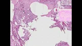 Histopathology Lung  Aspiration pneumonia [upl. by Zednanreh]