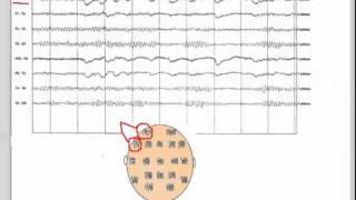 EEG  101 [upl. by Oniratac75]