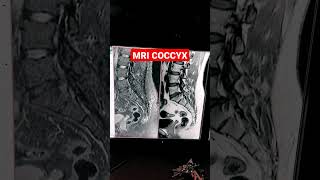 MRI of Coccyx  Post Traumatic Fracture mri shorts mriradiographer MRI L S Spine with Coccyx [upl. by Ibloc430]