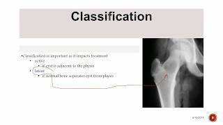 Unicameral Bone Cyst [upl. by Eisdnyl]