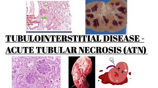 ACUTE TUBULAR NECROSIS  TUBULOINTERSTITIAL DISEASE PART 01 IMAGES [upl. by Nievelt883]