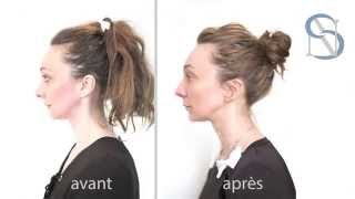 Ulthera ou Ultherapy au Centre Laser International de la PeauParis CLIPP [upl. by Aili]