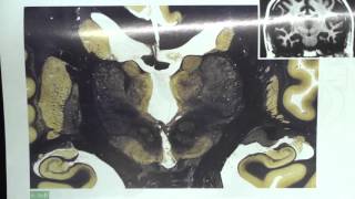 Thalamic Nuclei Brain Sections [upl. by Ella866]