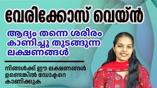 വേരിക്കോസ് വെയ്ൻ കാരണമെന്ത്   Varicose Vein Malayalam varicoseveins [upl. by Wyon]