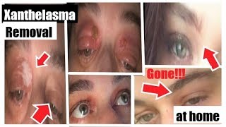 Xanthelasma Removal at Home With Wartner Pen My Subscribers Amazing Results Before amp After Photos [upl. by Quarta447]