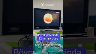 Böyrək daşı əməliyyatı Retrograde İntrarenal Surgery RİRS uroloq androloq [upl. by Aisat]