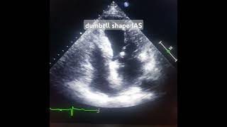 Lipomatous hypertrophy IAS cardiac benign tumor [upl. by Aynam784]