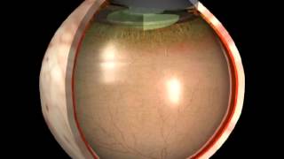 Posterior Vitreous Detachment [upl. by Lerrad39]