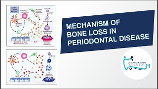 MECHANISM OF BONE LOSS IN PERIODONTAL DISEASERANKRANKLOPG AXISRANKLOPG RATIODR ANKITA KOTECHA [upl. by Lyrred]