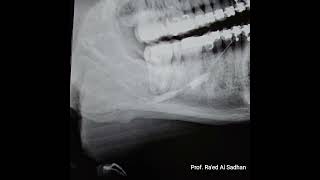 Submandibular Sialography of a Sialolith stone moving in the duct and causing partial obstruction [upl. by Anelys]