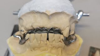 Como Enfilar Dientes En Estructuras De Cromo Cobalto [upl. by Damicke550]