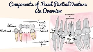 Fixed Partial Denture Components Advantages Objectives Retainer Pontic Connector FPD vs RPD [upl. by Kelula]