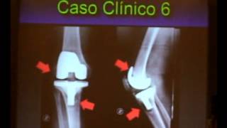 USO DE ESPACIADORES EN RODILLA DR EFRAIN DÍAZ dvd40 2 [upl. by Holey860]