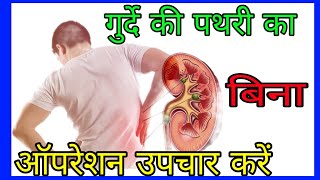 Easy Removal of Kidney Stones [upl. by Itram]