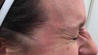 Before and After Botox around Eyes Results [upl. by Ruffo]