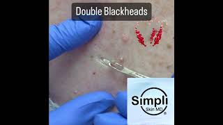 Double Blackhead Extraction Satisfaction [upl. by Ancell]