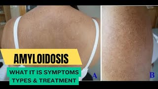 Amyloidosis What It Is Symptoms Types amp Treatment [upl. by Allison]