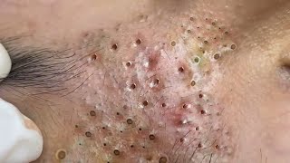 Big Cystic Acne Blackheads Extraction Blackheads amp Milia Whiteheads Removal Pimple Popping  3923 [upl. by Thinia577]