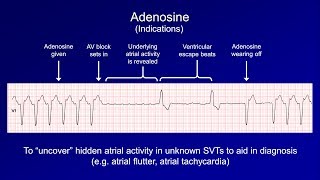 Antiarrhythmics Lesson 6  Digoxin Adenosine Atropine Isoproterenol and Ivabradine [upl. by Asert151]