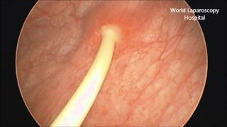 Removal of Double J stent by Cystoscopy [upl. by Aehtla]