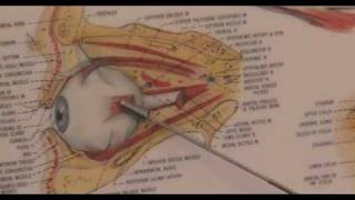 Eye Surgery While Awake Allows Patients to Help Surgeon [upl. by Ecertal]