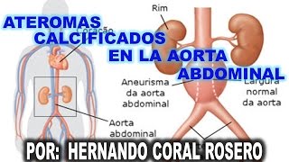 ATEROMAS CALCIFICADOS EN LA AORTA ABDOMINAL [upl. by Holub]