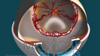 3D Medical Animation  5 Stages ROP [upl. by Ecinahs]