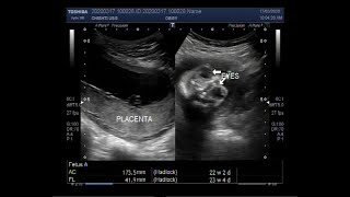 Ultrasound Video showing Anencephaly a neural tube defect [upl. by Airahcaz]