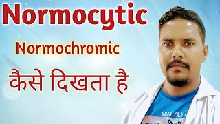 normocytic normochromic in hindi  Normocytic anemia  RBC indices in hindi [upl. by Sasha871]