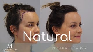 Female Hair Transplant FUT Hairline Lowering2150 GraftsMaitland ClinicDr Ball [upl. by Acirretal835]