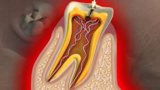 What is Caries [upl. by Weig]