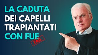 La caduta dei capelli trapiantati con la tecnica FUE [upl. by Neral]